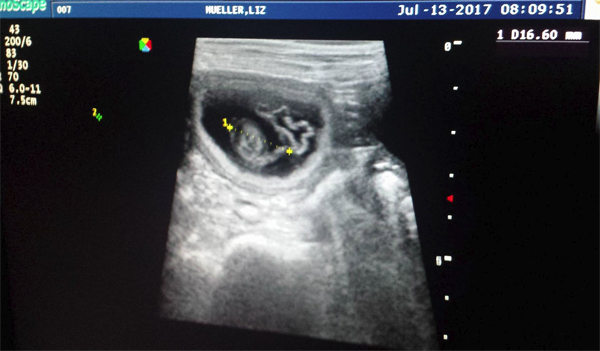 ultraschall